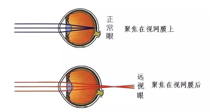远视眼和正常视力的眼球对比