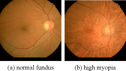 近视度数高的人,近视导致眼底裂了 近视度数高的人,近视导致眼底裂了