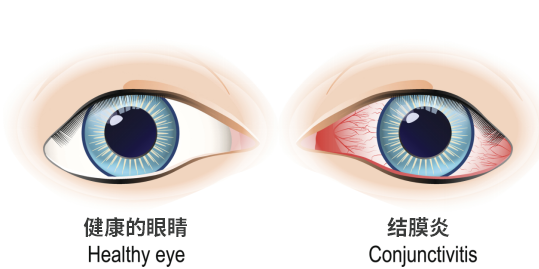 眼睛结膜发炎示意图