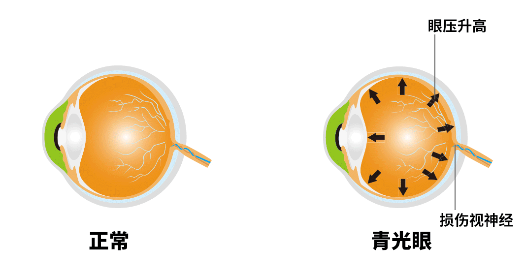 青光眼,青光眼有哪些症状 青光眼,青光眼有哪些症状
