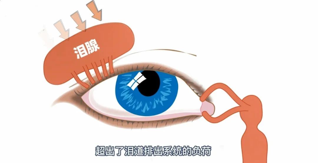 干眼属于一种慢性疾病