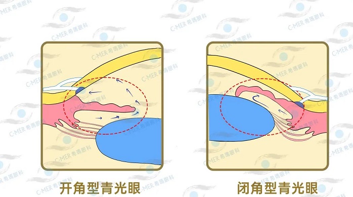 青光眼 青光眼