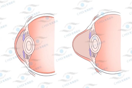 圆锥角膜 圆锥角膜