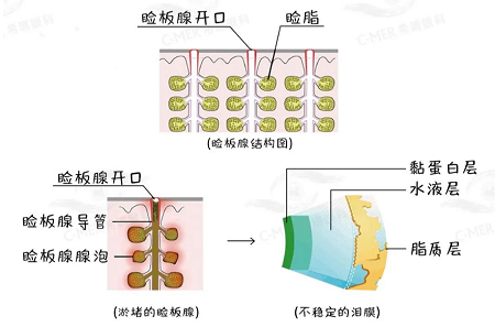 干眼症,按摩治疗干眼症,睑板腺究竟该怎么按摩 干眼症,按摩治疗干眼症,睑板腺究竟该怎么按摩
