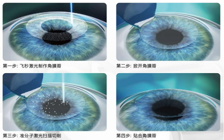 近视眼手术适合人群,近视手术的要求有哪些,哪些人不适合激光近视手术 近视眼手术适合人群,近视手术的要求有哪些,哪些人不适合激光近视手术