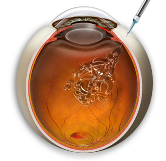 黄斑前膜,黄斑裂孔,黄斑劈裂,黄斑变性