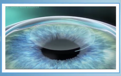 角膜塑形镜,近视,珠海希玛眼科