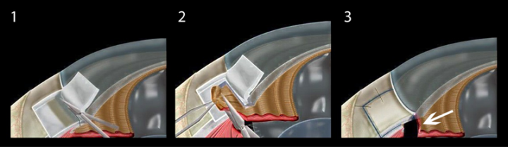 青光眼,高度近视患者,用眼过度,珠海希玛眼科