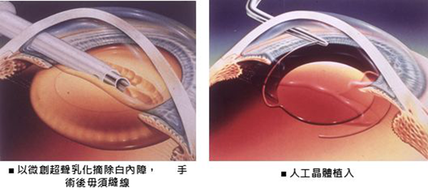 白内障手术的二次革新——飞秒白内障手术-惠州希玛林顺潮眼科医院 白内障手术的二次革新——飞秒白内障手术-惠州希玛林顺潮眼科医院