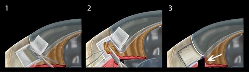 青光眼,青光眼治疗,青光眼症状,珠海希玛眼科医院