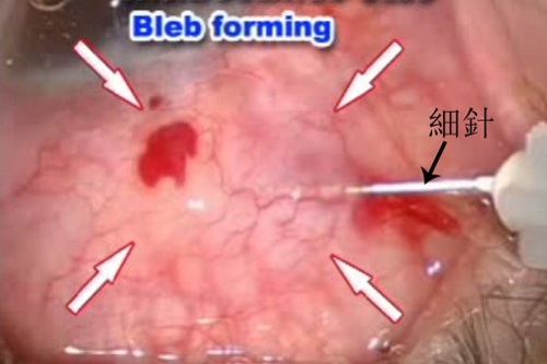 青光眼,青光眼治疗,青光眼症状,珠海希玛眼科医院