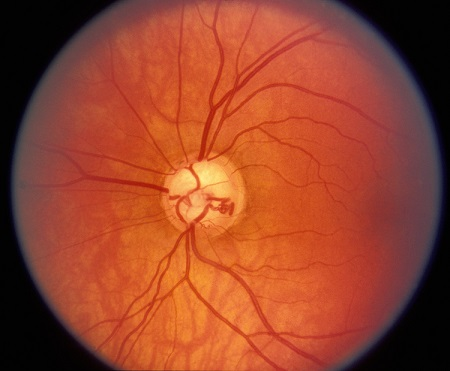 青光眼,青光眼的症状,青光眼治疗.珠海希玛林顺潮眼科医院 青光眼,青光眼的症状,青光眼治疗.珠海希玛林顺潮眼科医院