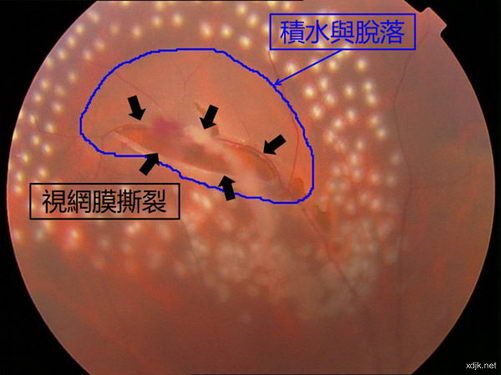 希玛眼科医院：视网膜脱落更爱找上这几类人