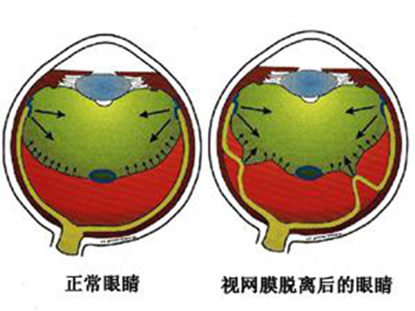 青光眼,珠海青光眼治疗,珠海青光眼治疗医院 青光眼,珠海青光眼治疗,珠海青光眼治疗医院