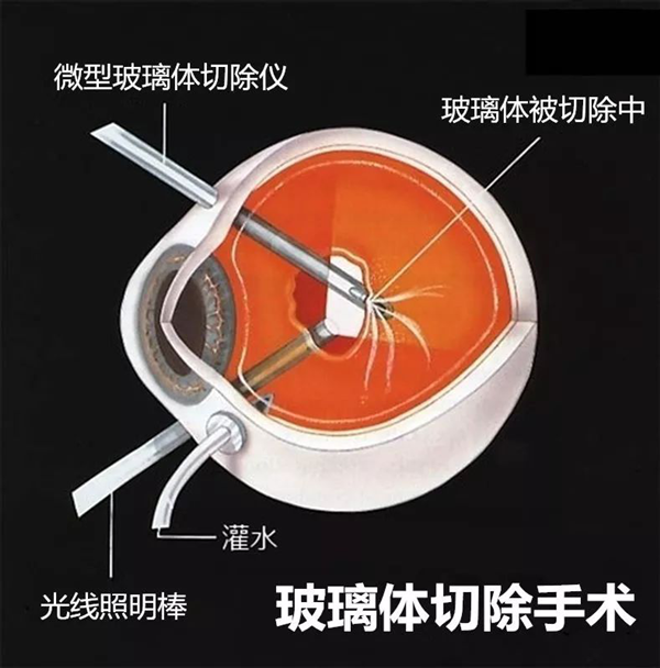 视网膜脱落,珠海视网膜脱落怎么办,视网膜脱落治疗医院