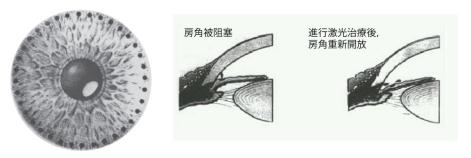 珠海青光眼哪家好,珠海青光眼好的医院,珠海青光眼治疗办法 珠海青光眼哪家好,珠海青光眼好的医院,珠海青光眼治疗办法