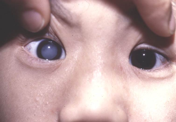 珠海眼哪里可以眼检查,眼检查的重要性,珠海小孩用眼检查吗