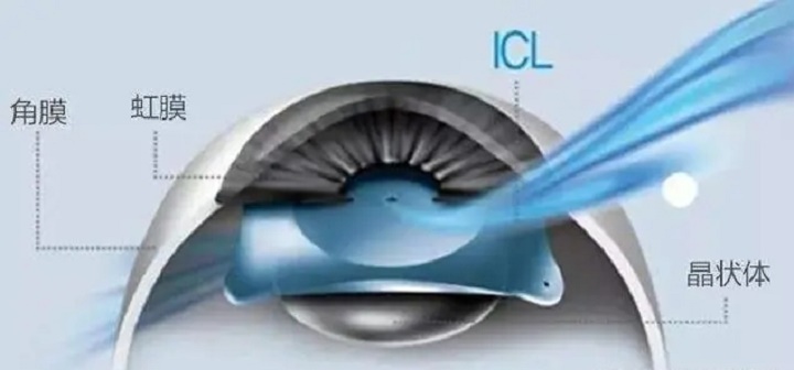  ICL有晶体眼人工晶体植入术