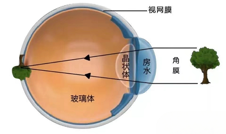高度近视会造成视网膜脱落吗