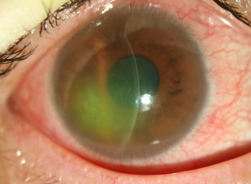 近视,近视手术,眼角膜,珠海希玛眼科医院
