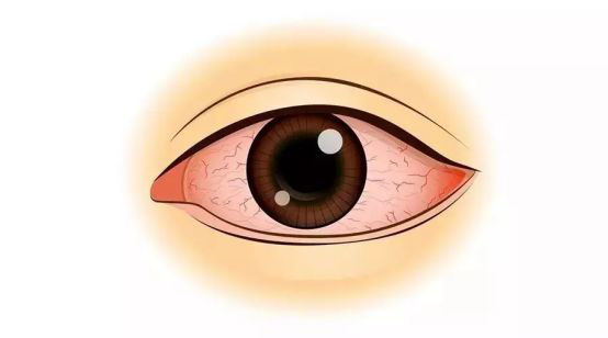 葡萄膜炎,红眼病,视力下降,珠海希玛眼科医院