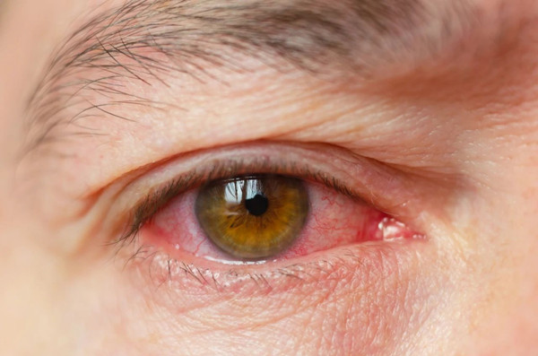 视网膜脱落,珠海飞蚊症治疗,珠海希玛林顺潮眼科医院