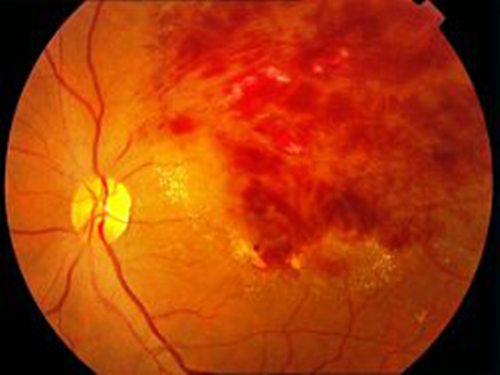 视网膜静脉阻塞怎么办,珠海视网膜医院哪家好,珠海眼科医院排名