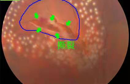 视网膜裂孔怎么办,飞蚊症症状是什么,珠海飞蚊症医院哪家好