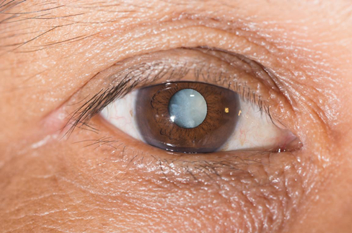 青光眼的治疗方法,怎么预防青光眼,珠海治疗青光眼的地方