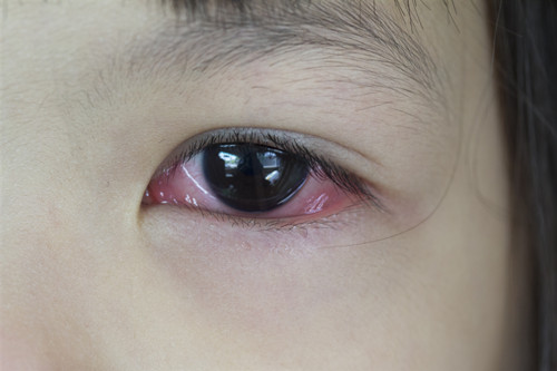 眼睛受伤怎么办,眼睛受伤去哪家眼科医院,眼睛受伤急救方法