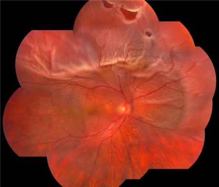 视网膜,视网膜脱离,高度近视,视网膜脱离治疗,玻璃体切除手术